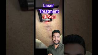 Laser treatment Keloid scar shorts [upl. by Ennasil]