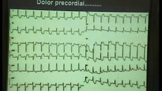 Curso ECG 2010  01 Fibrilación Ventricular [upl. by Delgado]