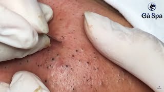 Best Blackhead Removal Ever 55min  Facial Acne Treatment  Gà Spa [upl. by Anilejna788]