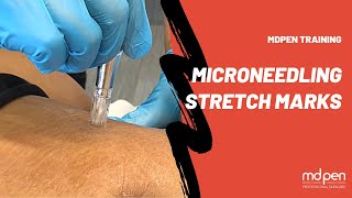 STRETCH MARKS MICRONEEDLING PROCEDURE  MDPEN TRAINING [upl. by Eran]