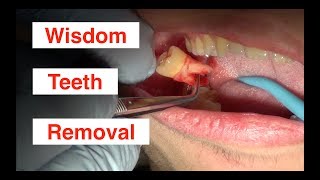 Wisdom Teeth Removal [upl. by Volnay779]