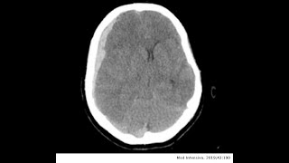 HEMATOMA SUBDURAL CAUSAS SÍNTOMAS Y TRATAMIENTO CLAVES DIAGNÓSTICAS [upl. by Valera215]