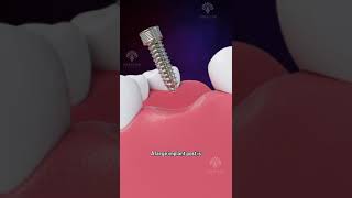 Bone Grafting for Dental Implants shorts facts  creativelearning3d [upl. by Morice23]