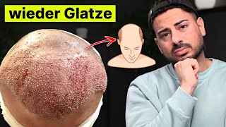 4 Jahre nach der Haartransplantation Wieder Glatze  Erfahrung [upl. by Arodoeht819]