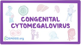 Congenital CMV  causes symptoms diagnosis treatment pathology [upl. by Rehtaef184]