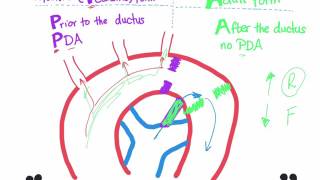 Coarctation of aorta Infantile type vs adult type mnemonic [upl. by Murrah]