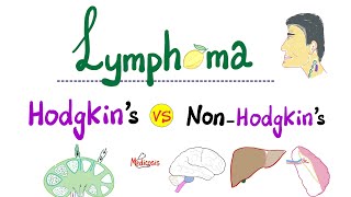 Hodgkin’s Lymphoma vs NonHodgkins Lymphoma  Comparison  Hematology and Oncology [upl. by Nylsor]