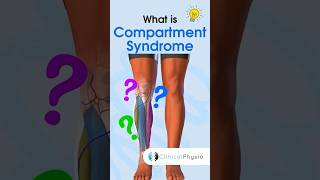 Compartment Syndrome anatomy physicaltherapy physiotherapy compartmentsyndrome [upl. by Ecnatsnok]