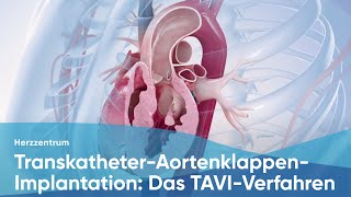 TranskatheterAortenklappenImplantation Das TAVIVerfahren [upl. by Onivla]