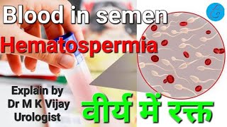 Blood in semen  Hematospermia causes diagnosis treatment in hindi [upl. by Haroppizt355]