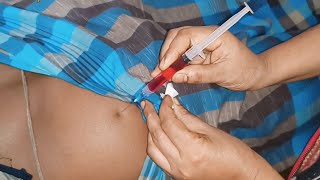 ivf buttock injection video Neuralgin Intramuscular injection buttock injection push 24 Ep 25 [upl. by Erdah]