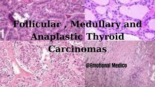 Follicular  Medullary and Anaplastic Thyroid Carcinomas  emotionalmedico [upl. by Hcnarb579]