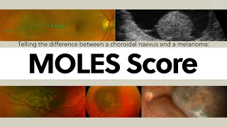 Telling the difference between a choroidal naevus and a melanoma The MOLES Score  OT Skills Guide [upl. by Goodill902]