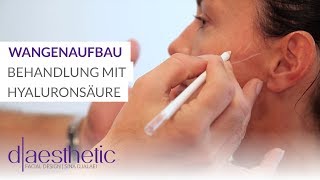 Wangenaufbau  Behandlung mit Hyaluronsäure  daesthetic [upl. by Nelyahs]