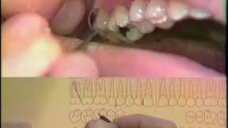 Periodontal Charting Procedure [upl. by Derr]