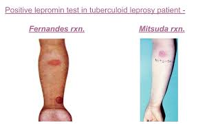 Lepromin test pathology mbbs [upl. by Tila]