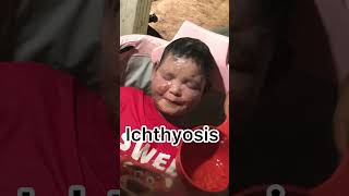 Ichthyosis skincare Ichthyosis eczema [upl. by Shermie]