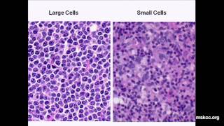 What You Need to Know about NonHodgkins Lymphoma Presentation [upl. by Novyert870]