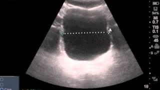 Ultrasound Estimated PostVoid Residual Bladder [upl. by Retse103]