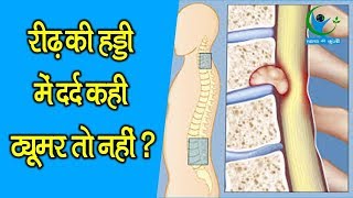 रीढ़ की हड्डी में दर्द रहना ट्यूमर का है संकेत SPINAL CORD PAIN IS THE SIGN OF TUMOR [upl. by Trometer]