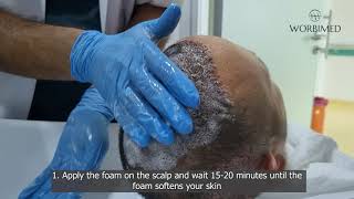 How to remove scabs after 10 days hair transplant  Hair Transplant Turkey [upl. by Wehttan]