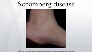 Schamberg disease [upl. by Abixah]