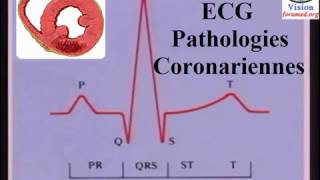 Interprétation de LÉlectrocardiogramme ischémie et infarctus du myocarde [upl. by Kelley240]