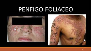 DERMATO  TEO 12 Enfermedades Ampollares [upl. by Lhamaj]