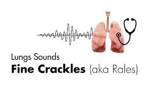 Fine Crackles Rales  Lung Sounds  MEDZCOOL [upl. by Aeduj]