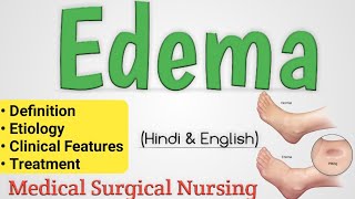 Edema  Edema In Hindi  Oedema [upl. by Ainitsirhc30]