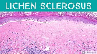 Lichen Sclerosus et atrophicus Inflammatory Dermpath Basics for Dermatology amp Pathology [upl. by Althee287]