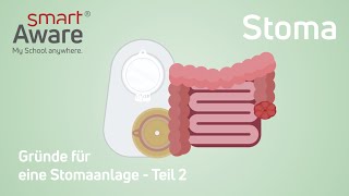 Stoma Gründe für eine Stomaanlage I Fachfortbildungen in der Pflege  smartAware [upl. by Esilenna]