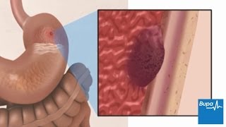 How a peptic ulcer develops  Bupa Health [upl. by Fredela96]