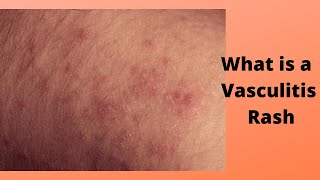 What is a Vasculitis Rash [upl. by Eiralam]