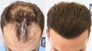 FUE Hair Transplant 3052 Grafts NW IIIVI Vertex By Dr Juan Couto  FUEXPERT CLINIC Madrid Spain [upl. by Genesia]