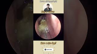 귀지형 콧물 부비동염 축농증 비염 코청소 이비인후과 rhinorrhea rhinitis sinusitis asmr ENT ENTdoctor [upl. by Gallard]