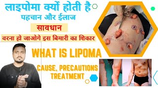 What Is Lipoma Cause Symptoms Treatment lipoma liposuction imk improvemedicalknowledge [upl. by Onaicram]