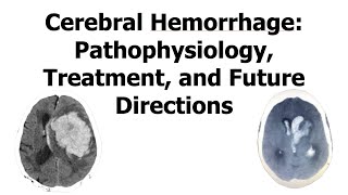 Cerebral Hemorrhage Pathophysiology Treatment and Future Directions [upl. by Ynamad867]