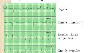 Basic Dysrhythmias [upl. by Georgi363]