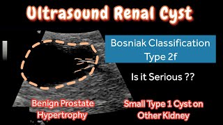 Renal Cyst Type 2f Bosniak Classification  Ultrasound  other Kidney Type 1 Small Cyst  Treatment [upl. by Kyl931]