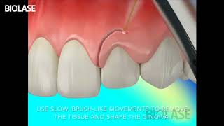 Gingivectomy Laser [upl. by Jacobs]