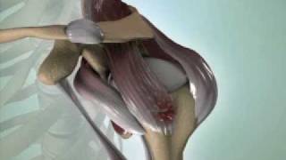 Torn Rotator Cuff Causes Symptoms amp Treatment  DePuy Videos [upl. by Moreland966]