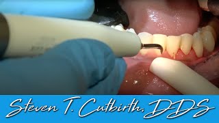 Scaling amp Root Planing  Dental Minute with Steven T Cutbirth DDS [upl. by Voletta]