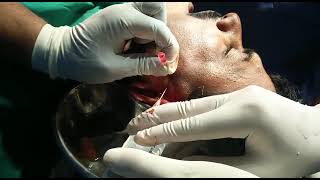 Arthrocentesis Procedure TMJ [upl. by Sedgewinn409]