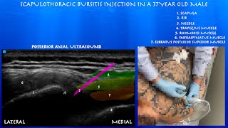 Ultrasound Guided Scapulothoracic Bursa Injection by probeultrasound [upl. by Htebazie325]