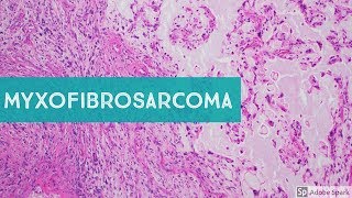 Myxofibrosarcoma 101Explained by a Sarcoma Pathologist [upl. by Ahsayn]