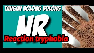 Reaction tryphobia tangan bolong bolong  penyakit tangan [upl. by Senga]