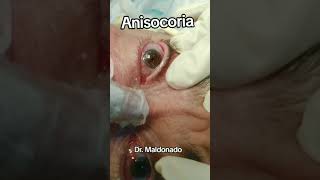 ANISOCORIA medicina seguridad ciencia sabiasque emergency curiosidades tratamientos [upl. by Bristow]