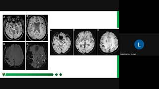 Angiopatia Amilóide Cerebral [upl. by Kinnard]