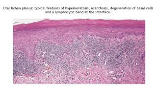 Lecture43 Lichen Planus and Lichenoid disorders Rooks chapter 37 [upl. by Lucien244]